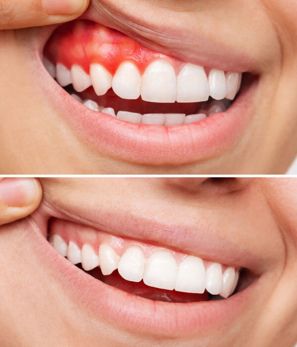 Gum treatment